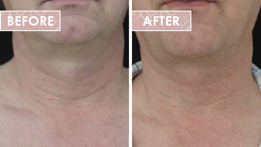 Vinesse-Aesthetics-and-Cosmetic-Clinic-HIFU-Before-After-04
