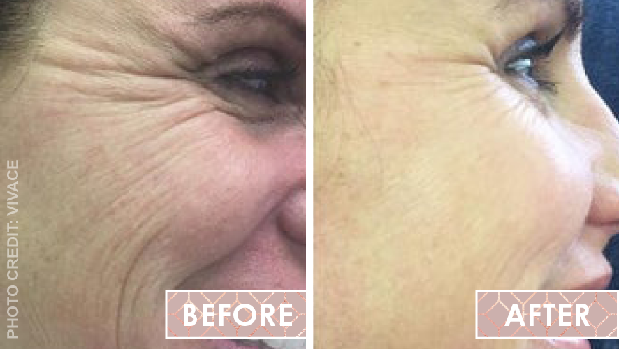 Micro-needling Vivace Before After