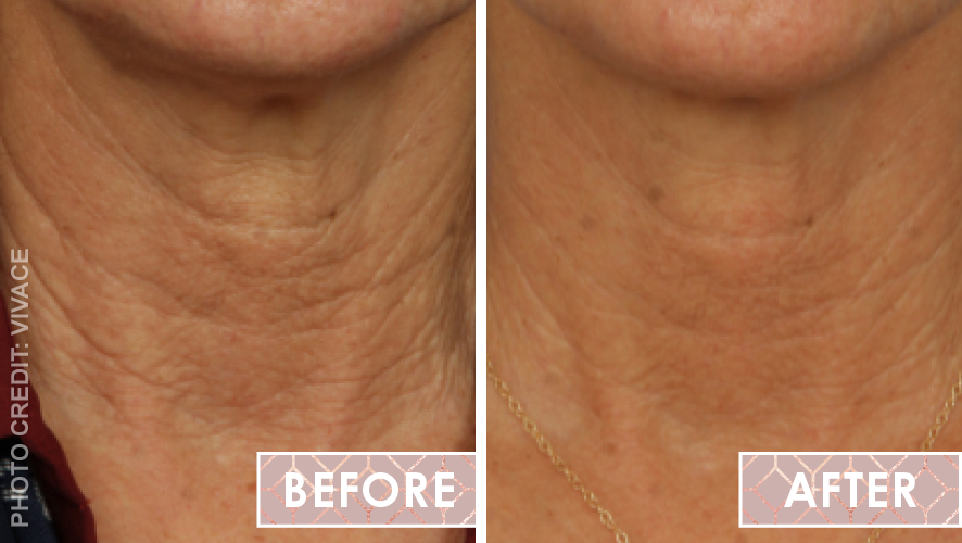 Micro-needling Vivace Before After