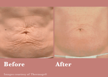 Thermage FLX-Digi-Before-After-Body-0
