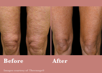 Thermage FLX-Digi-Before-After-Body-0