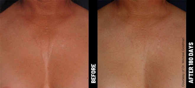 Ultherapy-Before-After-BA_chest@1x