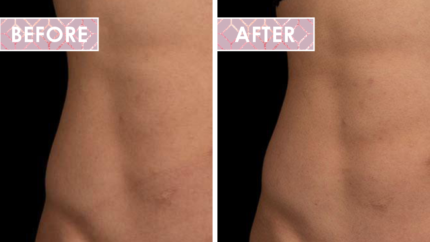 Vinesse-Aesthetics-and-Cosmetic-Clinic-Results-Trusculpt-Flex-before-after-02.png
