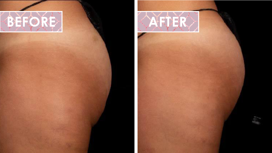 Vinesse-Aesthetics-and-Cosmetic-Clinic-Results-Trusculpt-Flex-before-after-03.png