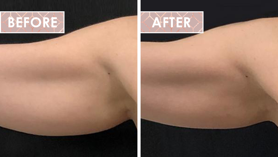 Vinesse-Aesthetics-and-Cosmetic-Clinic-Results-Trusculpt-ID-0.png