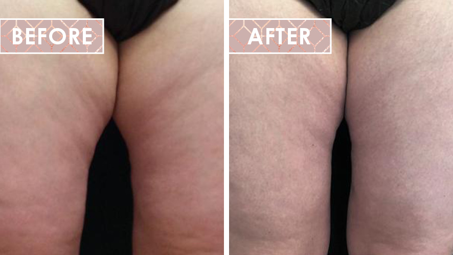Vinesse-Aesthetics-and-Cosmetic-Clinic-Results-Trusculpt-ID-02.png